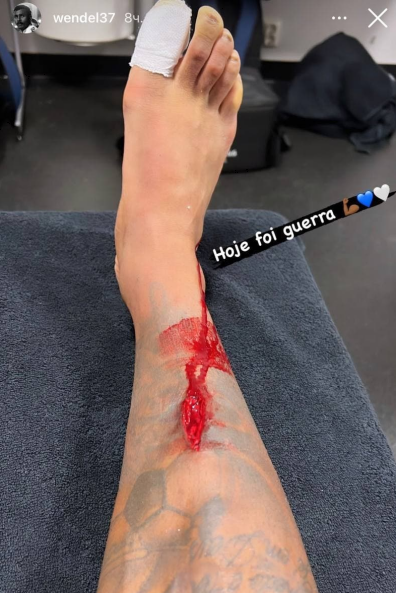 Футболист «Зенита» Вендел показал жуткое фото окровавленной ноги после матча с «Мальме»